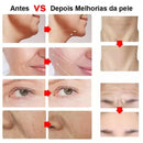 Ultrassom Facial  Microfocado Portátil LiftPro™